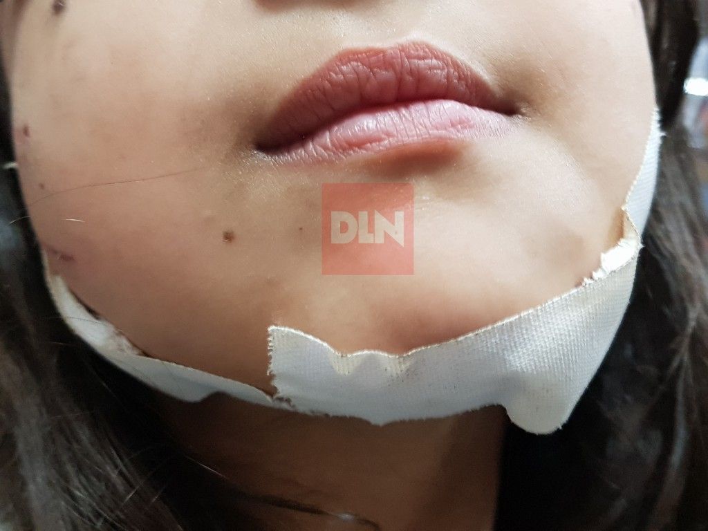 BRANDSEN: Un perro Pitbull atacó a una nena de 6 años 4